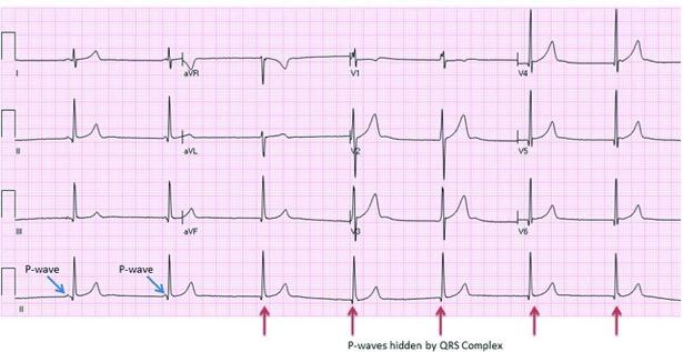 A 28-year-old asymptomatic Caucasian handball player demonstrating a junctional escape rhythm (red arrows).