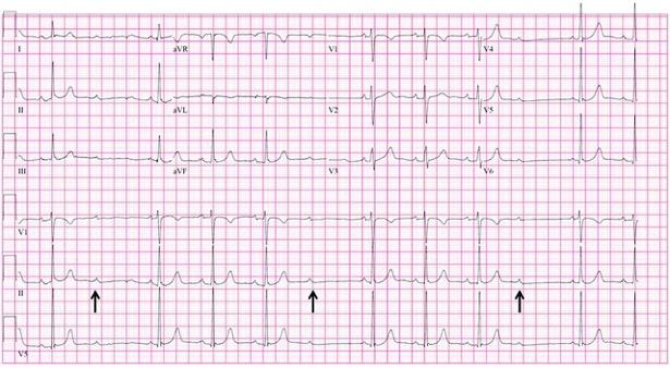 ECG shows Mobitz type I (Wenckebach) second-degree AV block demonstrated by progressively longer PR intervals until there is a non-conducted P-wave (arrows) and no