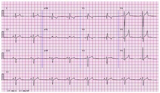ECG from an asymptomatic 22-year-old black male athlete demonstrating complete right bundle branch block (QRS 120 ms), left axis deviation ( 57 ) and right atrial enlargement (P wave 2.