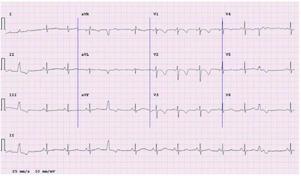 ECG from a 30-year-old patient with ARVC showing anterior TWI in V1-V3 preceded by a flat or