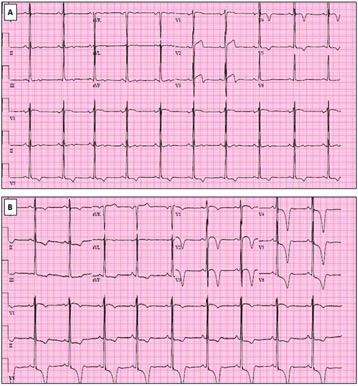 (A) ECG from an 18-year-old black basketball player demonstrating abnormal