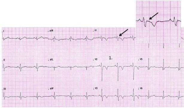 ECG in a young athlete with arrhythmogenic right ventricular cardiomyopathy showing several abnormal features including anterior T wave inversion (V1 V4) preceded by a nonelevated J-point and ST