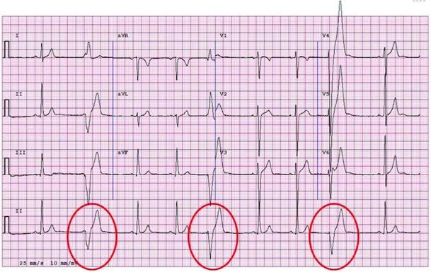 ECG from a patient with arrhythmogenic right ventricular