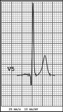 A 5-mm Q wave in lead V5 in a patient with hypertrophic cardiomyopathy. Abhimanyu Uberoi et al.