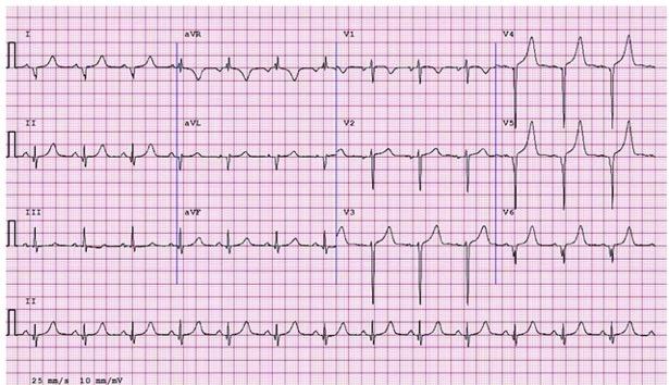 ECG from an 18-year-old female swimmer demonstrating deep and wide pathological Q waves in V4-V6, I and avl.
