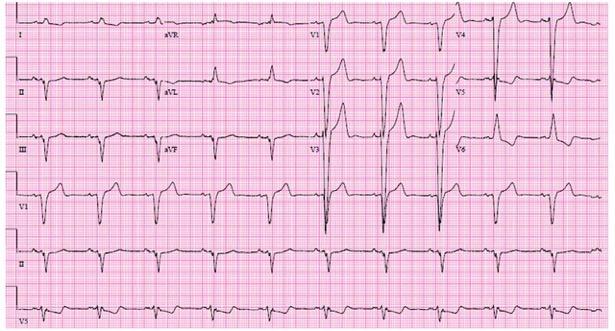 ECG with complete LBBB demonstrating a QRS 120 ms, predominantly negative QRS complex in lead V1, upright R wave in leads I and V6, and ST segments and T waves in the opposite direction of the QRS.