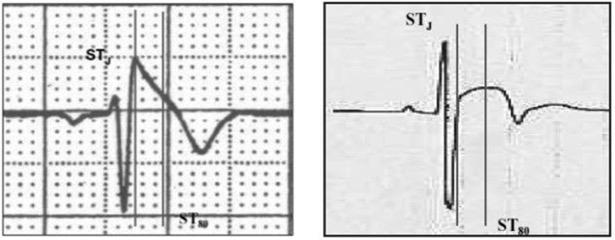 Brugada type 1 ECG (left) should be distinguished from early repolarisation with convex ST segment elevation in a trained athlete (right).