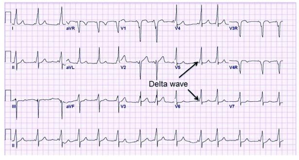 ECG demonstrating the classic findings of Wolf-Parkinson-White pattern with a short PR interval (<120 ms), delta wave (slurred QRS upstroke) and prolonged