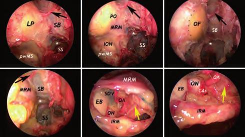 10 Endoscopic Orbital and Transorbital Approaches Anteriorly, the SOV stays on the medial aspect of the superior rectus muscle, and along its posterior course, the SOV runs below the superior rectus