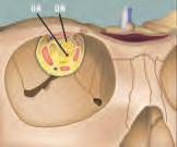 Once the medial intraconal fat has been gently removed, the intraorbital portion of the optic nerve with its tortuous course, comes into view.