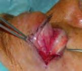 inferior eyelid. The eyeball is protected. Next, the lateral canthotomy incision is made.