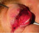 In a post-septal approach, no eyelid dissection is required. Alternatively, an inferior fornix conjunctival incision is performed.