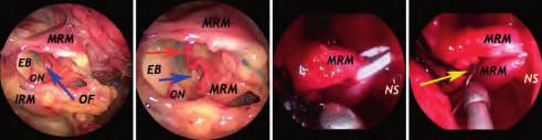 Ethmoidal complex (EC); inferior rectus muscle (IRM); inferior turbinate (IT); medial rectus muscle (MRM); maxillary sinus (MS); middle turbinate (MT); nasal septum (NS); optic nerve (ON); superior