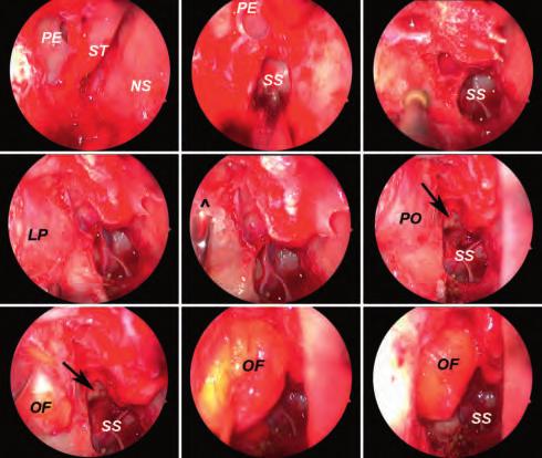 30 7 Endoscopic Orbital and Transorbital Approaches Selection of Clinical Case Histories 7.