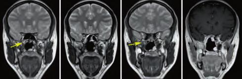 34 Endoscopic Orbital and Transorbital Approaches Case 5 Recurrence of Chondrosarcoma in the Pterygopalatine Fossa and Inferior Orbital Fissure Region Recurrence of chondrosarcoma involving the right