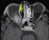 Medial rectus muscle ( ). A B C D E F G H Fig. 7.