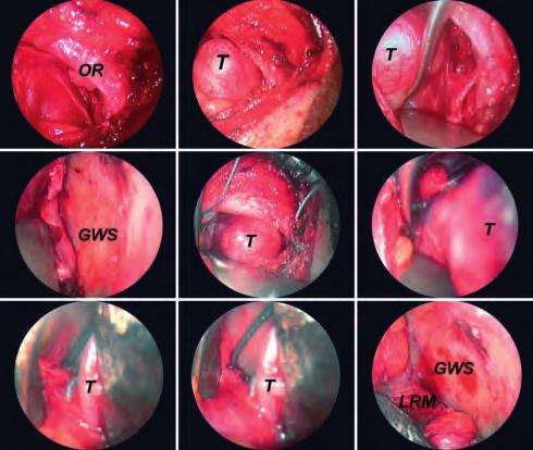Endoscopic-assisted dissection of the lesion was easily accomplished resulting in its complete removal. Final histopathological examination revealed a pleomorphic adenoma of the lacrimal gland. Fig.