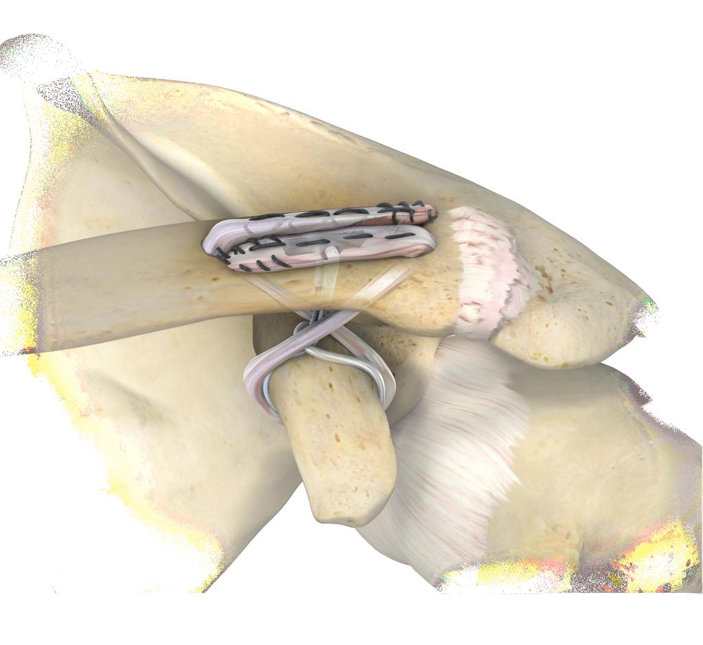 Coracoid Bone Conserving Acromioclavicular