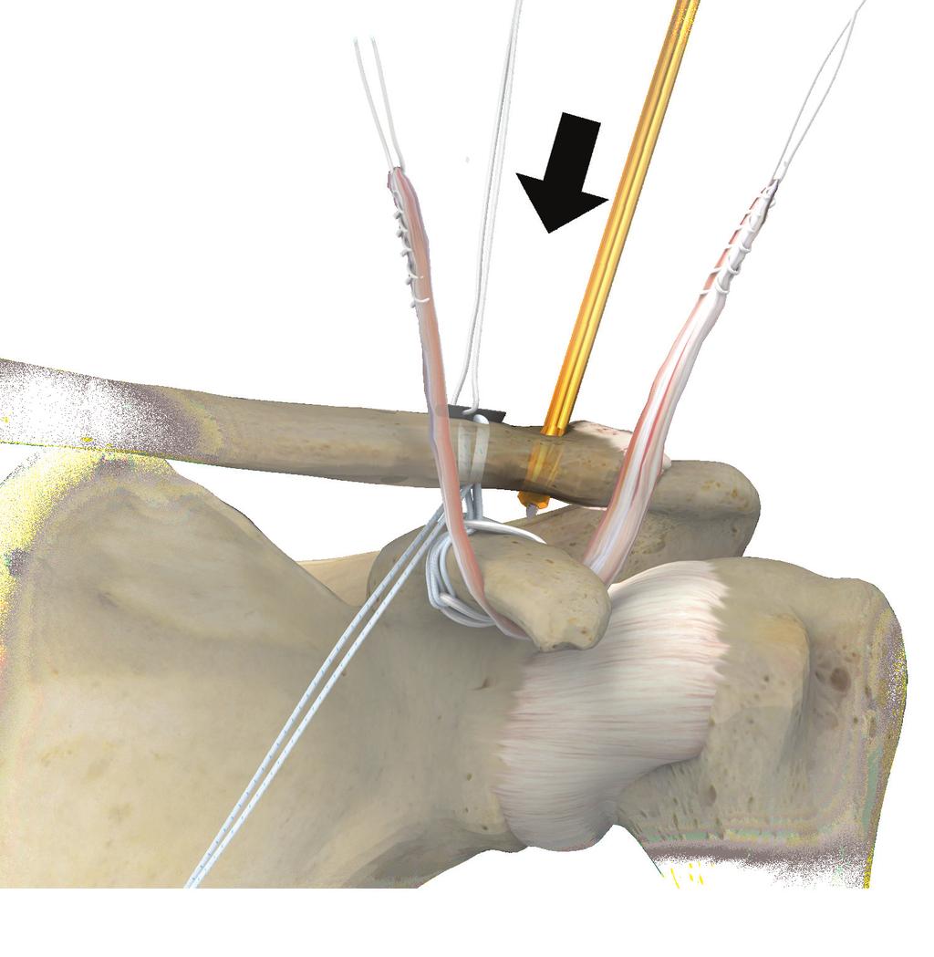Coracoid Bone Conserving Acromioclavicular Joint Reconstruction using ToggleLoc Device with ZipLoop Technology Figure 15 Figure 16 Figure 14 Figure 16a Graft Placement Two additional 3.