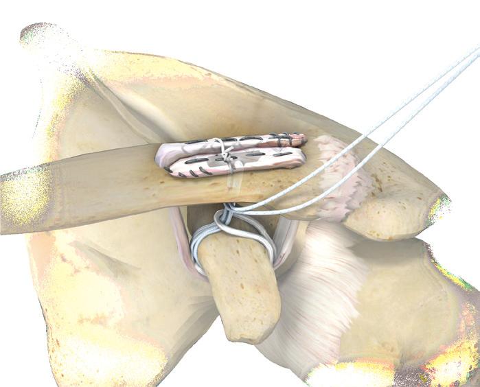 A Nitinol wire can be utilized to shuttle graft suture limbs to the superior clavicle. Once each limb of the graft is passed, the clavicle is reduced and the ZipLoop is tightened.