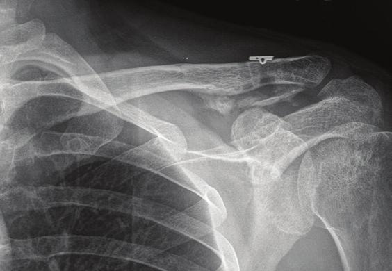 surface of the clavicle.