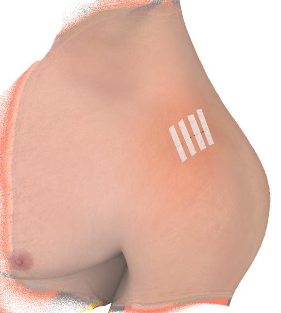 closure with steri-strips for an optimal cosmetic result (Figure 18).