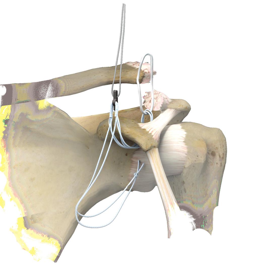 Coracoid Bone Conserving Acromioclavicular Joint Reconstruction using ToggleLoc Device with ZipLoop Technology Figure