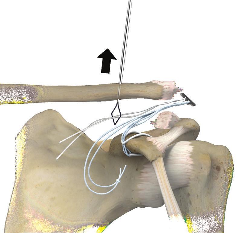 Coracoid Bone Conserving Acromioclavicular Joint Reconstruction