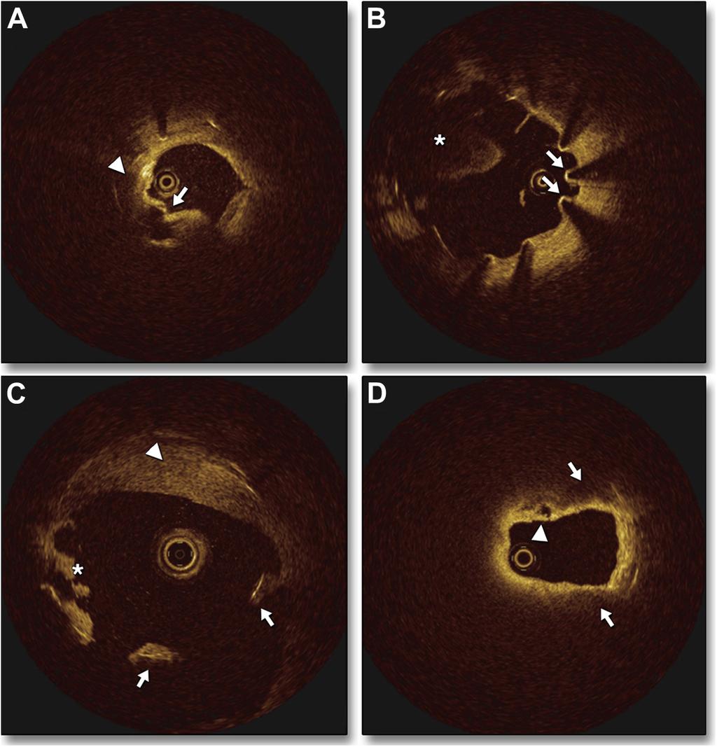 698 Kang et al. JACC: CARDIOVASCULAR IMAGING, VOL. 6, NO. 6, 2013 OCT and Very Late Stent Thrombosis JUNE 2013:695 703 Figure 1.