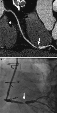 CCTA for Bypass Grafts For Bypass Graft Occlusion Sensitivity 99% Specificity 99% For Bypass Graft Stenosis> 50% Sensitivity 98 Specificity 98 For >50% stenosis Barbero U, et al.