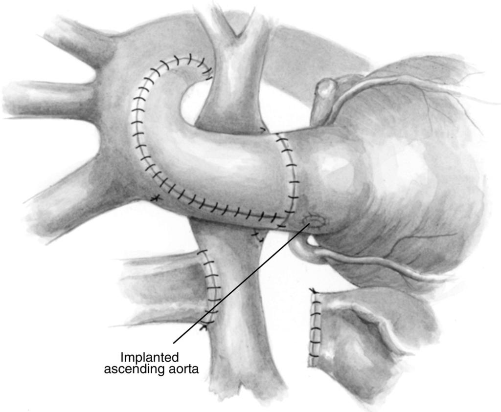 Hybrid approach to HLHS 85 Figure 11 The aorta is then reconstructed with a patch of pulmonary homograft.