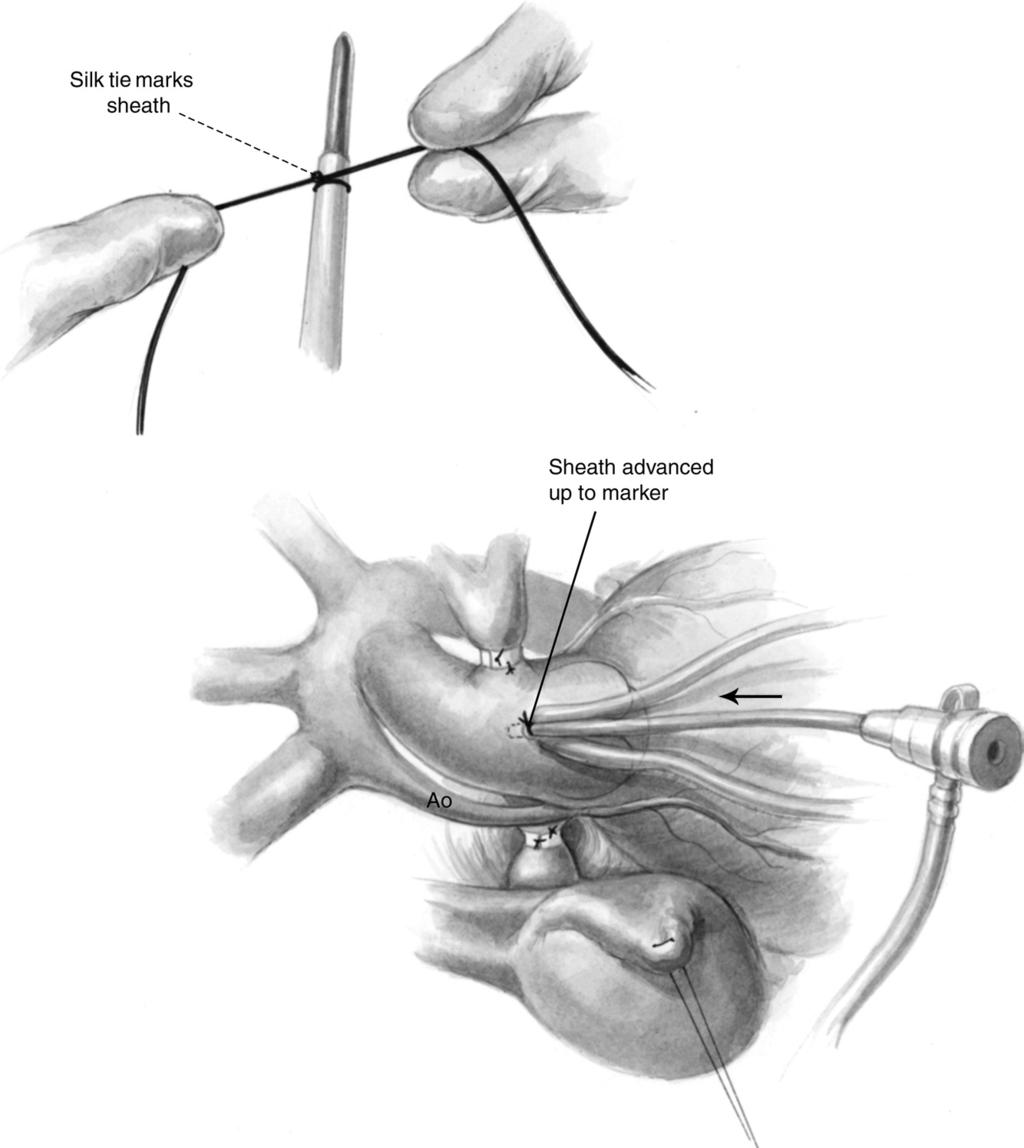 78 M. Galantowicz Figure 4 Direct sheath insertion in the main PA prevents a sheath or wire coursing through the heart from the femoral vein across the tricuspid and pulmonary valves en route to the