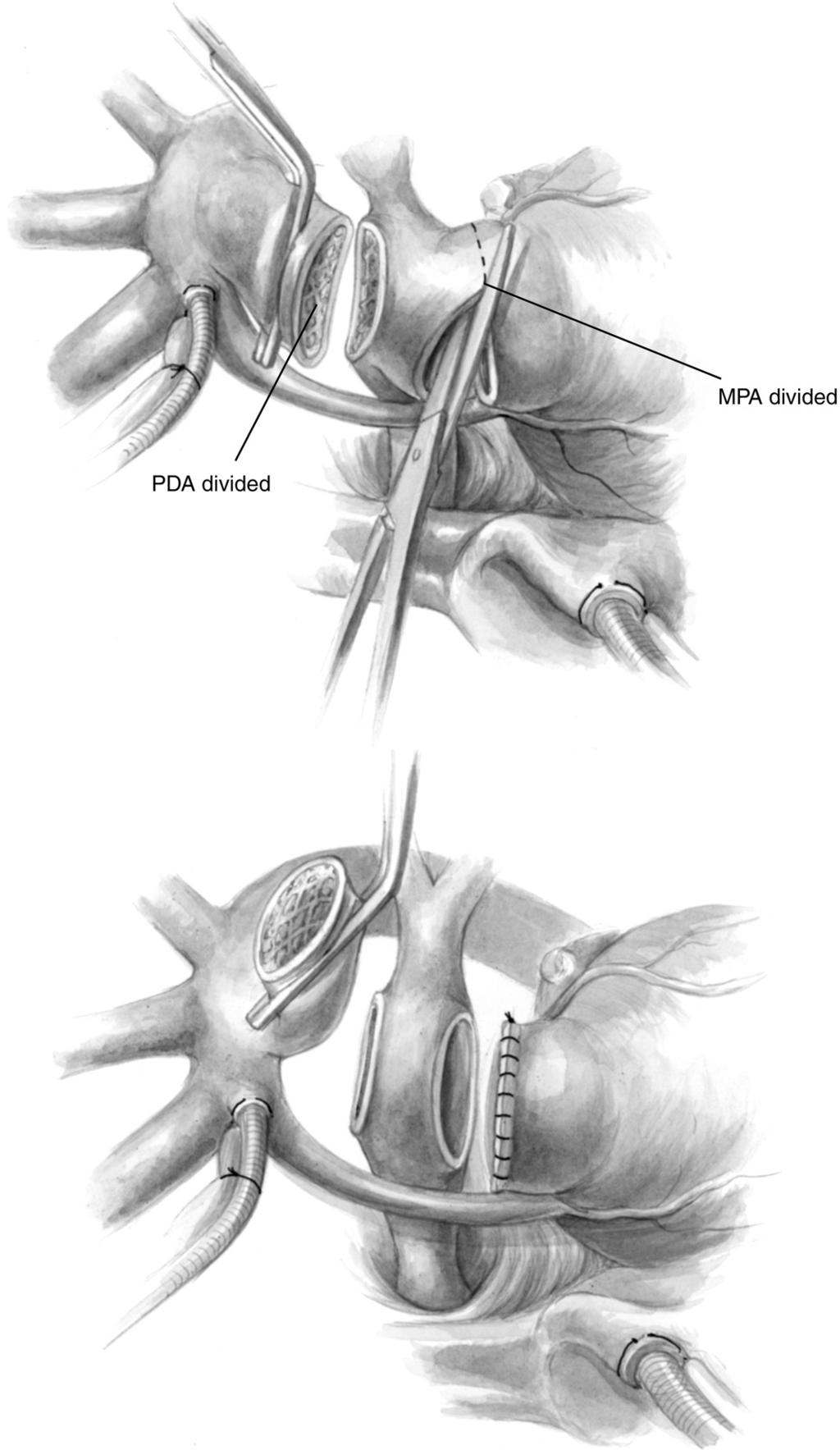 Hybrid approach to HLHS 81 Figure 7 Once the bands have been removed, the confluence of the pulmonary arteries is isolated by dividing first the PDA stent, and then the main pulmonary artery.