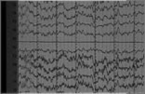 org/wnet/brain/scanning/) Electroencephalogram (EEG) Records electrical activity of the brain.