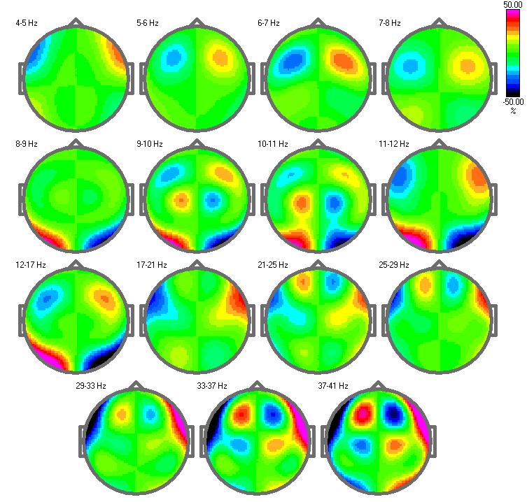 Asymmetry maps of power spectra in eyes open conditions for 1 Hz bands. Note that an asymmetry higher than 50% may be a sign of abnormality 7.