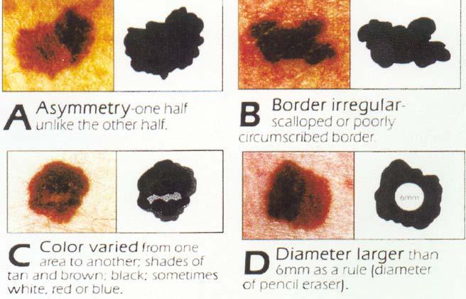 Skin Cancer Recognition - AAD Style Classic ABCD A = Asymmetry 1 side different than the other Color or texture