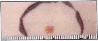 Skin Cancer Recognition - 101 Does it fit any ABCD criteria?