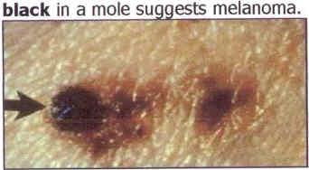 Smaller than an eraser Answer: Melanoma Does it fit any Casey