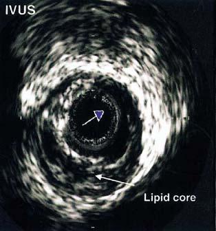 IVUS is the gold standard Invasive Expensive Only assesses proximal