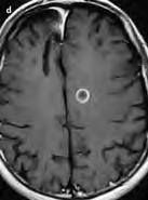 Multiple subcortical hyperintensities on T2-weighted MR images that are