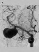 3 a c Saccular aneurysm of the trifurcation of the right middle