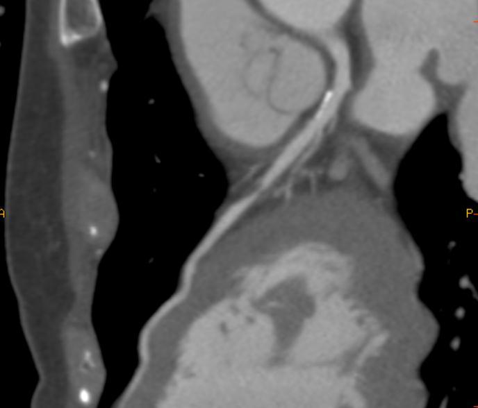 Case 1: Excellent correlation between CT Angiography and Coronary