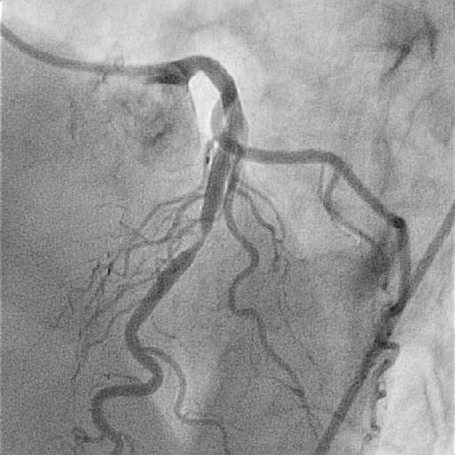 Angiography and