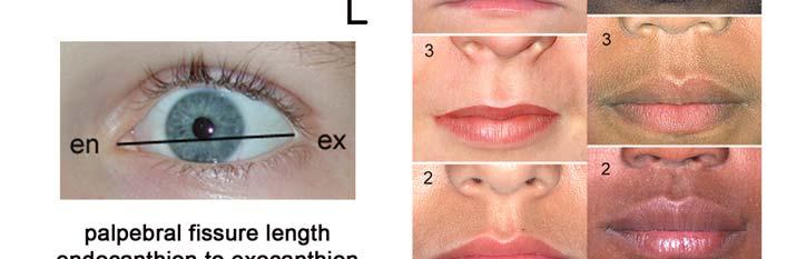 Smooth philtrum (rank 4 or 5) 3.