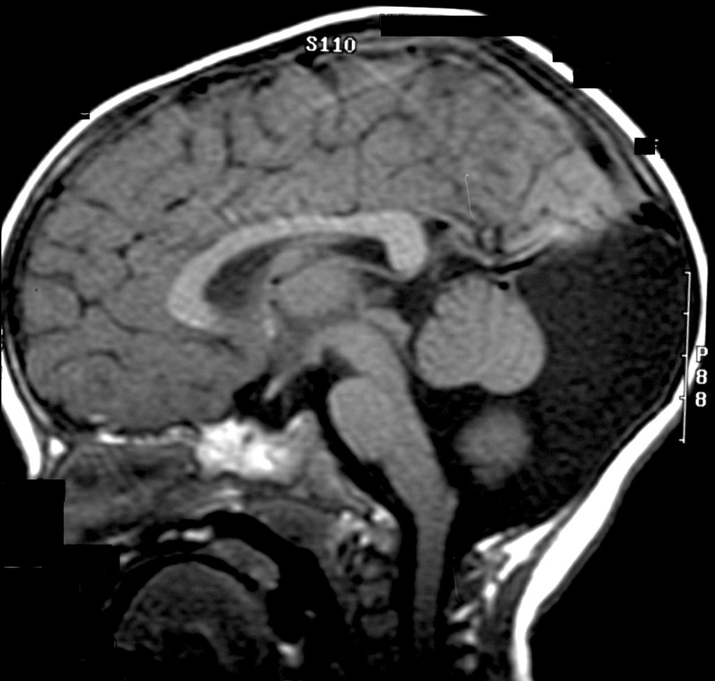 Complex Hydrocephalus Pathogenesis DWS develops at about the fourth week of gestation Associated with