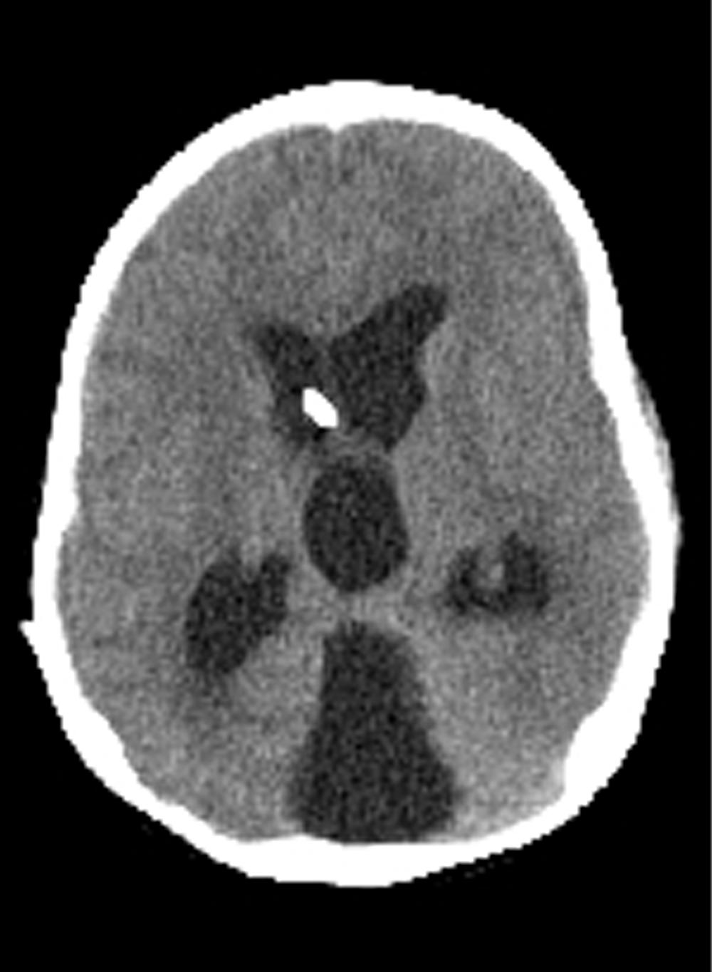 Complex Hydrocephalus Incidence of Hydrocephalus DWS occurs in 2-4% of cases of