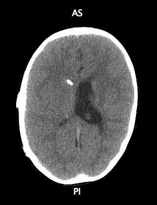 Isolated Lateral Ventricular Hydrocephalus Clinical signs of increased ICP Radiographic: Ventricular asymmetry +
