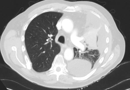 A Case About Why this is Important 66 yo developed cough late 11/14, fainting episode 12/14 Found to have lung adenocarcinoma with fluid surrounding heart.