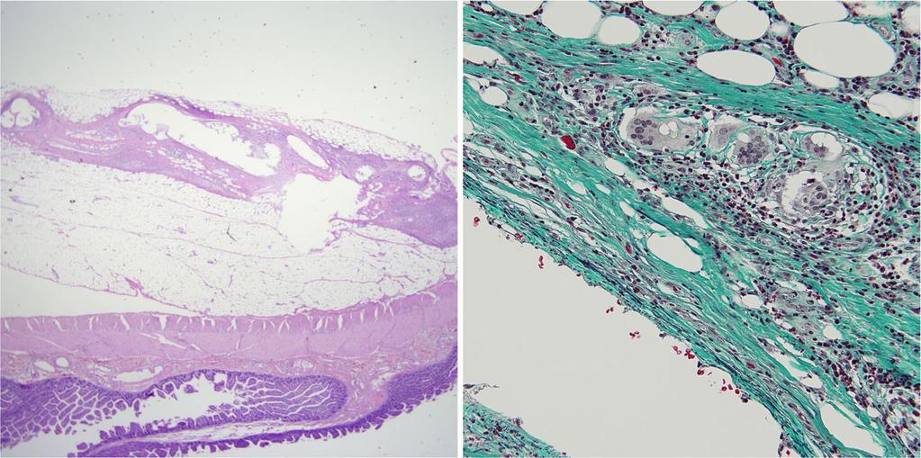 So et l. Surgicl Cse Reports (2018) 4:78 Pge 4 of 5 Fig. 4 Pthologicl exmintions of the resected tissue. Hemtoxylin nd eosin stining revels thickening of the vessels in the mesentery. Scle r, 200 μm.