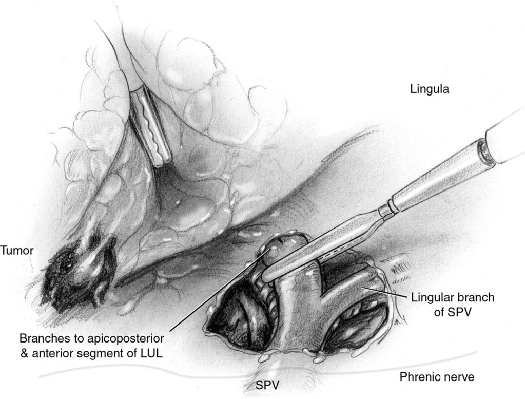 Lung segmentectomy for patients with peripheral T1 lesions 319 Figure 8 The overlying hilar pleura is entered and the left superior pulmonary vein is identified.
